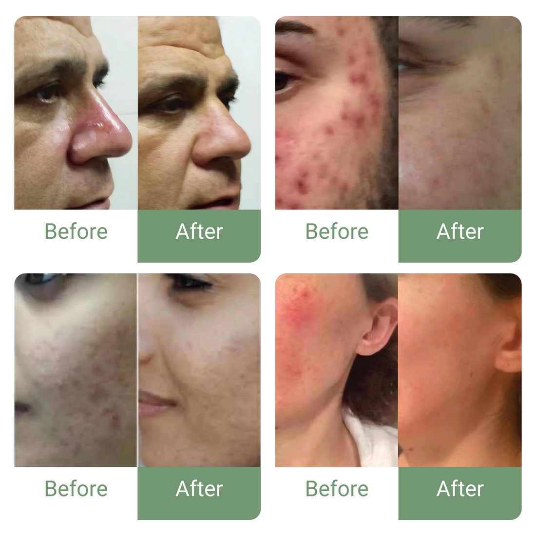 🔥 Marvesol® Rosacea After Care Cream – Buy 1, Get 50% Off 2nd Bottle 🧴✨