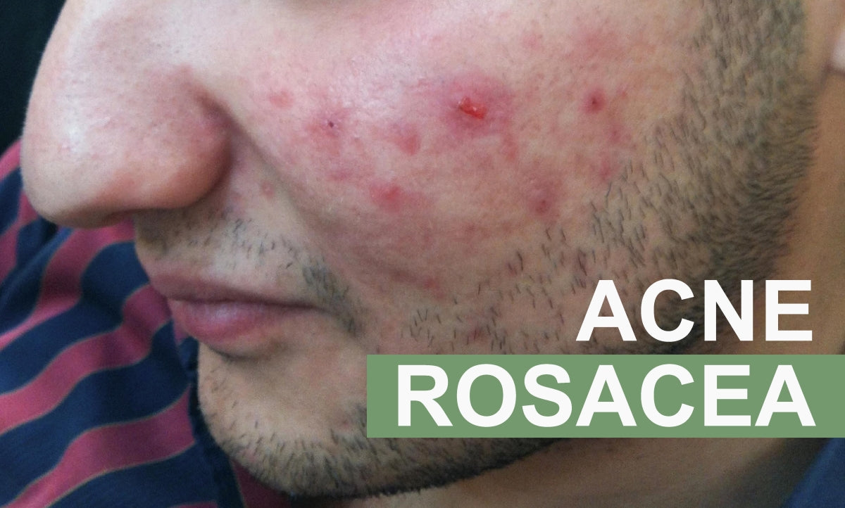 8 Facts about Acne Rosacea You Should Know