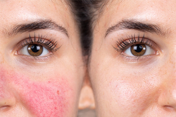 Unbelievable Transformations: Before & After Rosacea Photos