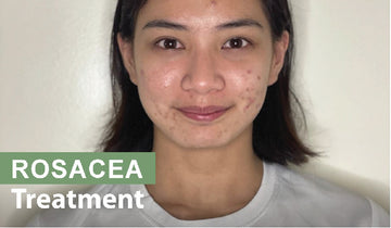 rosacea treatment