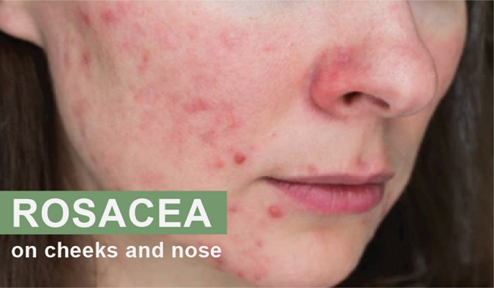 Rosacea on cheeks and nose - Skin condition