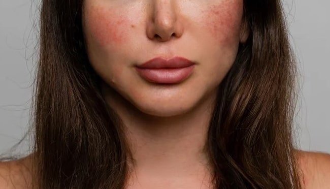 Causes of Rosacea – Your Ultimate Guide - Marvesol®