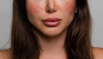 Causes of Rosacea – Your Ultimate Guide - Marvesol®