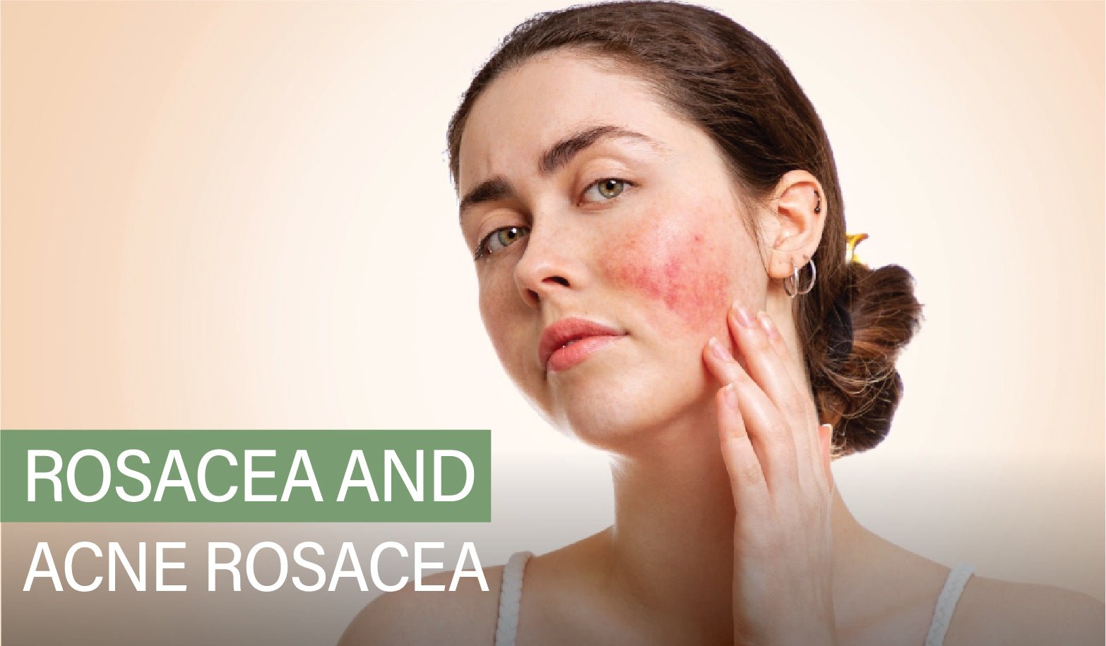 Rosacea and Acne Rosacea - What Do You Need To Know? - Marvesol®
