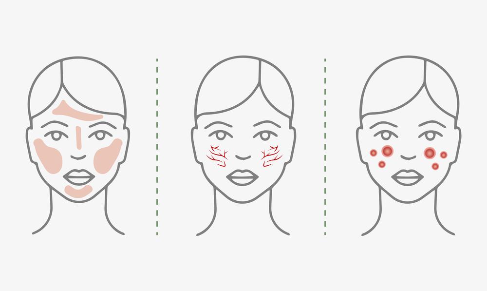 Where Rosacea Appears