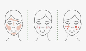 Where Rosacea Appears