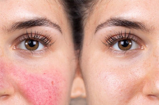Rosacea Transformation Before and After See the Skin Change. - Marvesol®