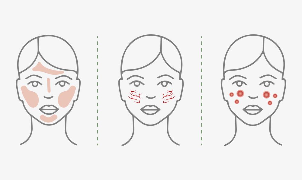 What is Rosacea? 6 Things you Need to Know - Marvesol®