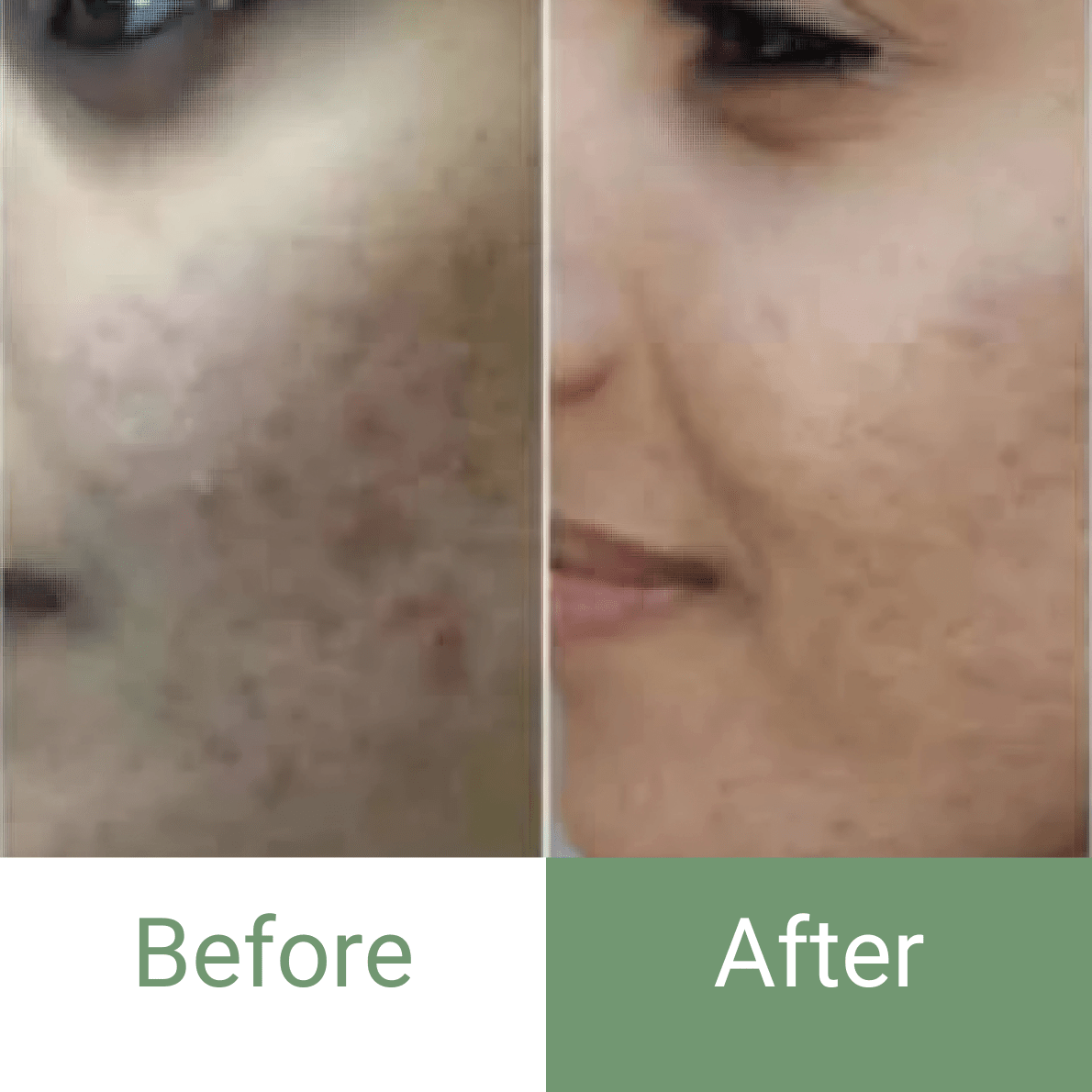 🔥 Marvesol® Rosacea After Care Cream – Buy 1, Get 50% Off 2nd Bottle 🧴✨ - Marvesol®