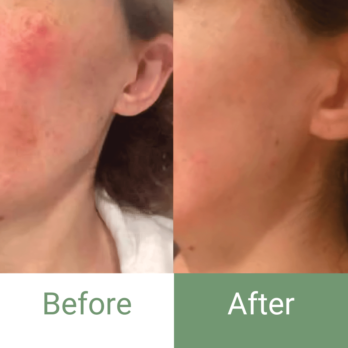 🔥 Marvesol® Rosacea After Care Cream – Buy 1, Get 50% Off 2nd Bottle 🧴✨ - Marvesol®