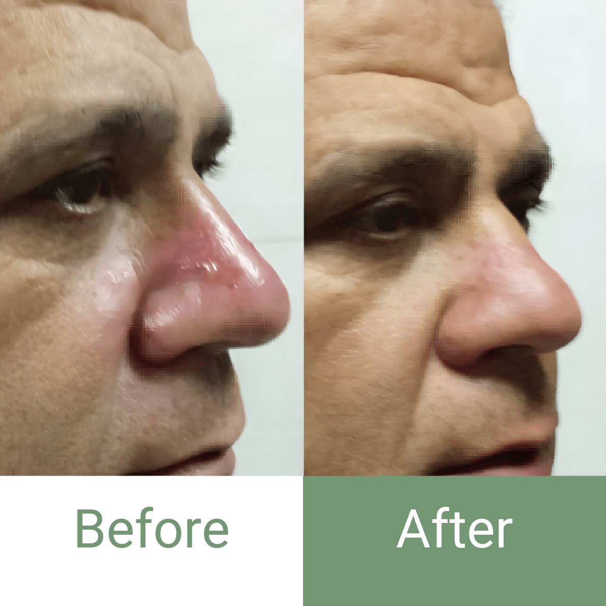 🔥 Marvesol® Rosacea After Care Cream – Buy 1, Get 50% Off 2nd Bottle 🧴✨ - Marvesol®