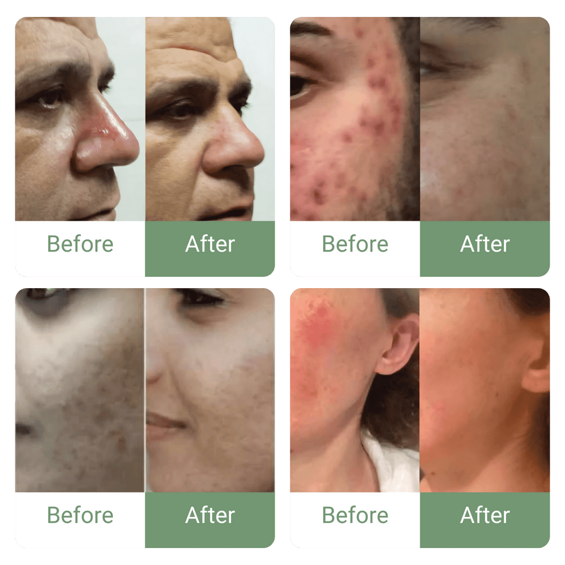 🔥 Marvesol® Rosacea After Care Cream – Buy 1, Get 50% Off 2nd Bottle 🧴✨ - Marvesol®