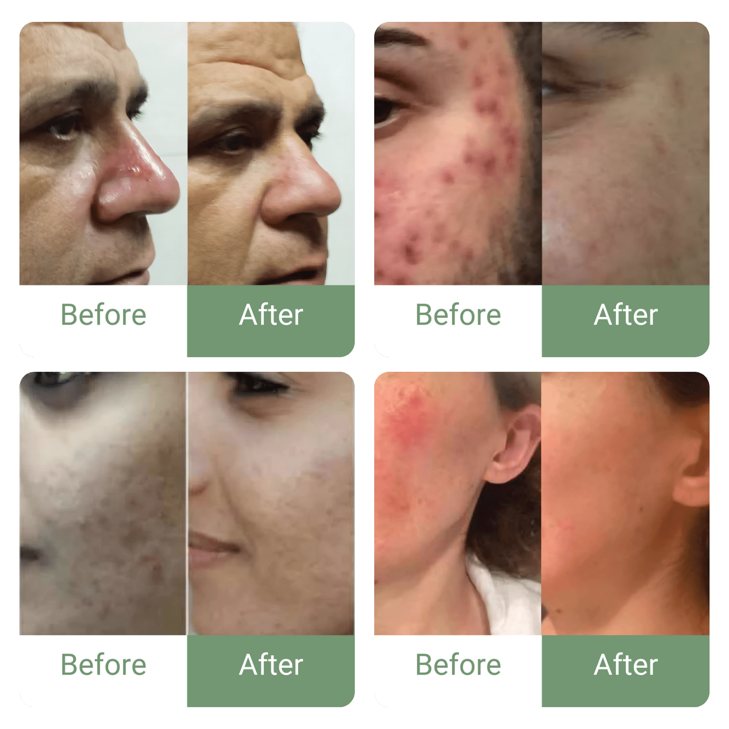 🔥 Marvesol® Rosacea After Care Cream – Buy 1, Get 50% Off 2nd Bottle 🧴✨ - Marvesol®